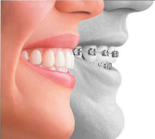 Image result for Dental Braces in Dwarka